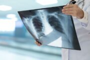 Why newly diagnosed lung cancer patients should get this test done before starting treatment